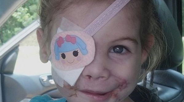 KFC expulse une petite fille de 3 ans défigurée, victime d’une attaque de pitbulls !