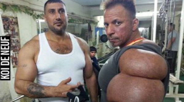 Synthol : des injections musclées !