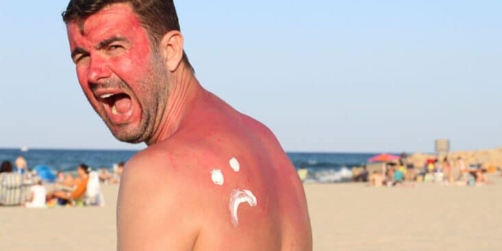 Coup de soleil : ne suivez jamais cette astuce très répandue pour le soigner c’est très dangereux